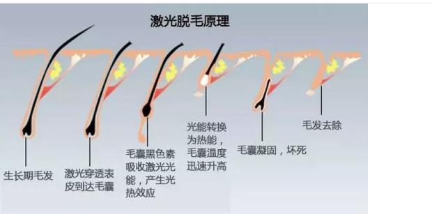 璀璨之光脱毛